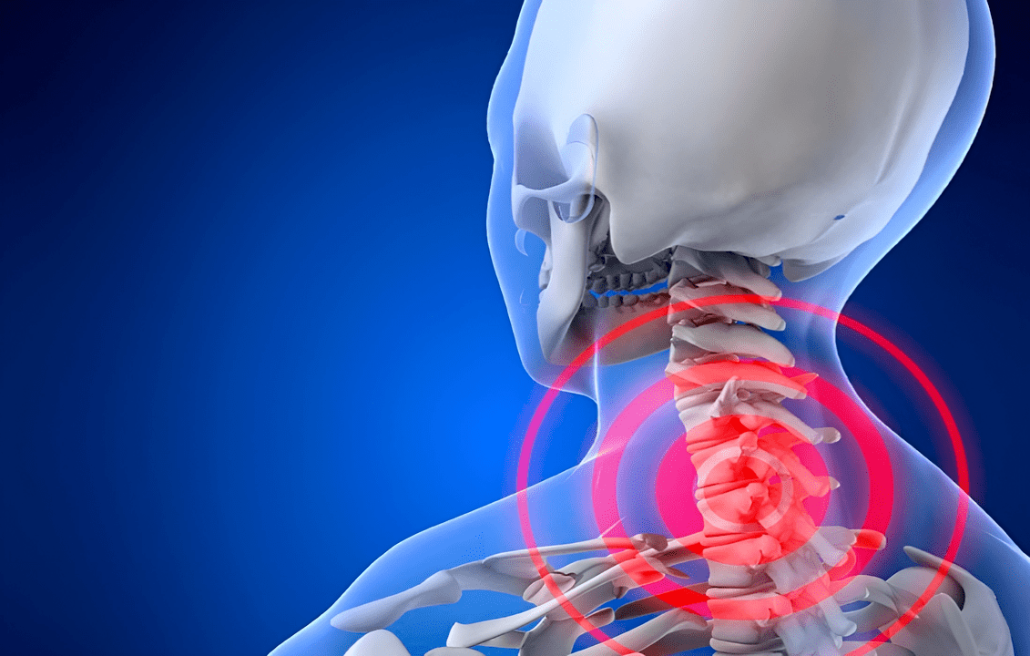 osteohondroza vratne hrbtenice