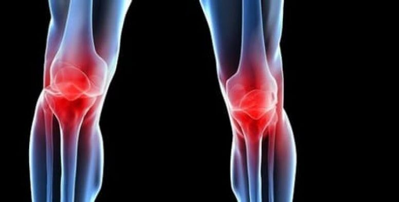 osteoartritis kolena