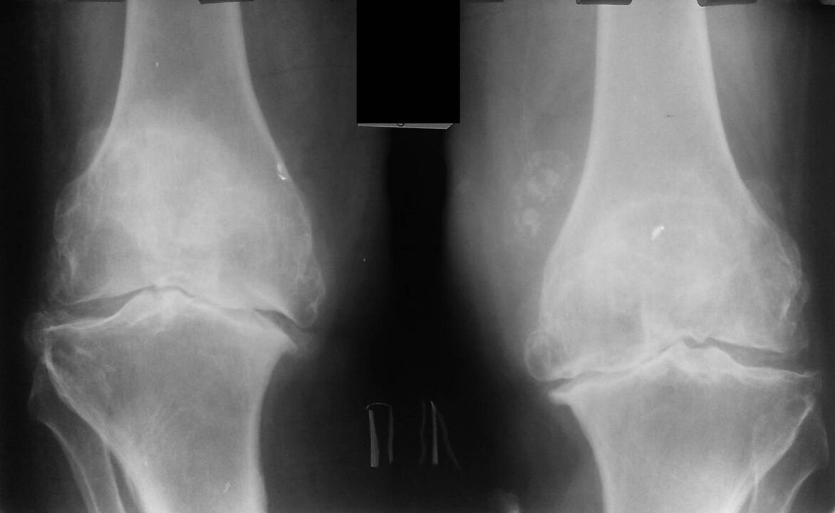 rentgensko slikanje kolenskih sklepov z artrozo