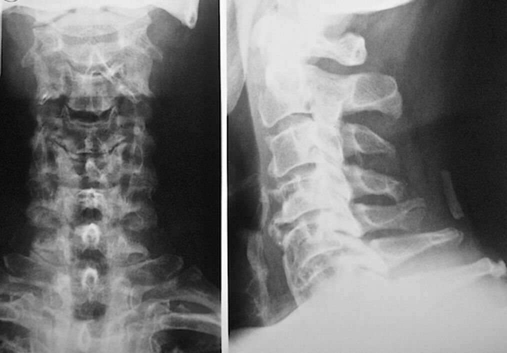 rentgenski pregled vratne hrbtenice z osteohondrozo