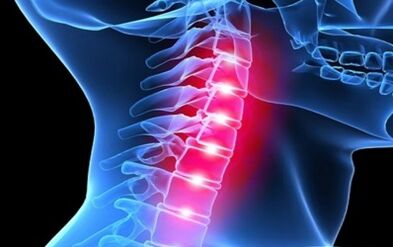 Simptomi osteohondroze vratne hrbtenice
