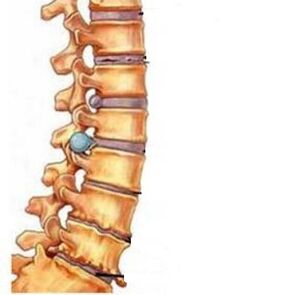 Kako se razvija osteohondroza regije materničnega vratu