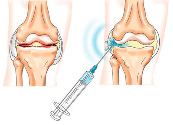 intraartikularne injekcije za artrozo kolena