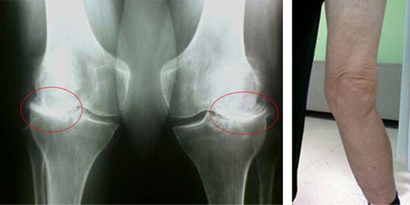 rentgensko slikanje osteoartritisa kolena