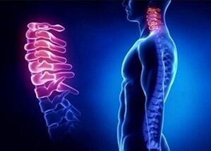Razlogi za razvoj osteohondroze materničnega vratu