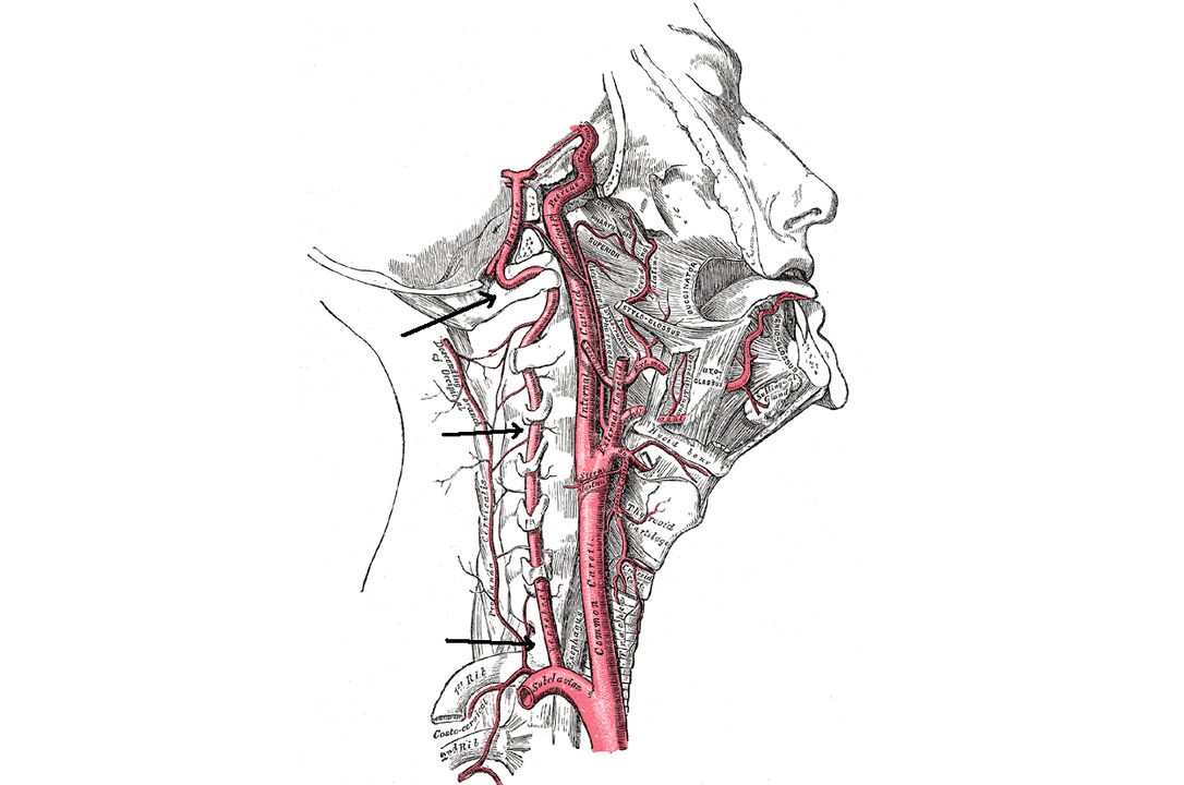 stiskanje vretenčne arterije s cervikalno osteohondrozo