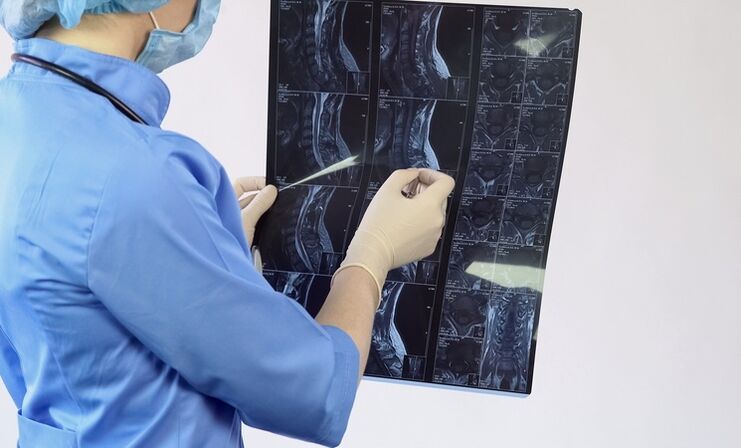 Diagnoza cervikalne osteohondroze se postavi na podlagi študije MRI